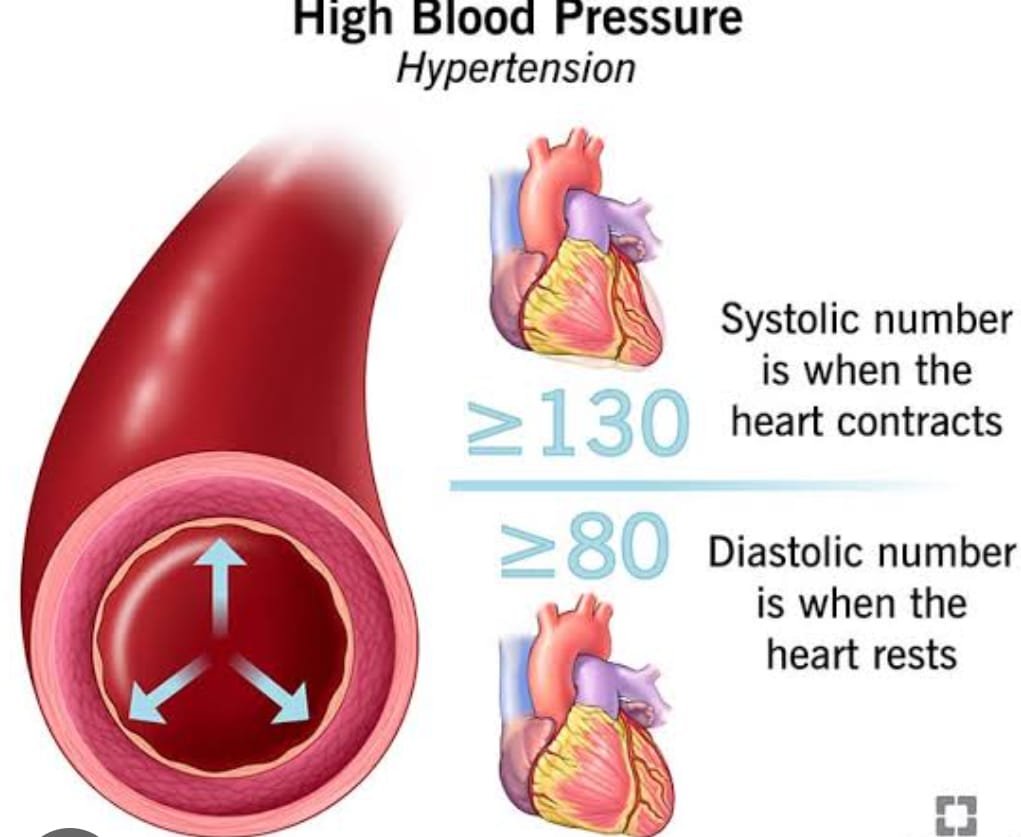 HIGH BLOOD PRESSURE IS 