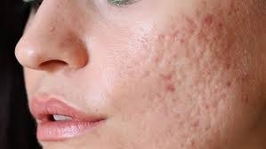 ACNE MARKS HAI PARESHAN