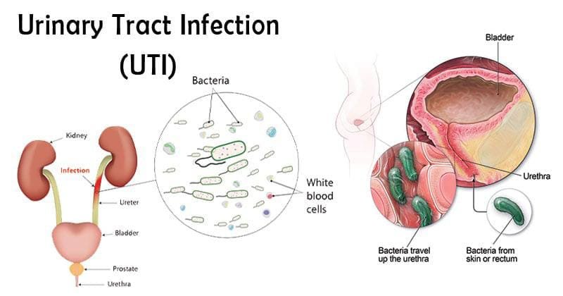 URINARY TRACT DISEASE KE BARE ME JANIYE